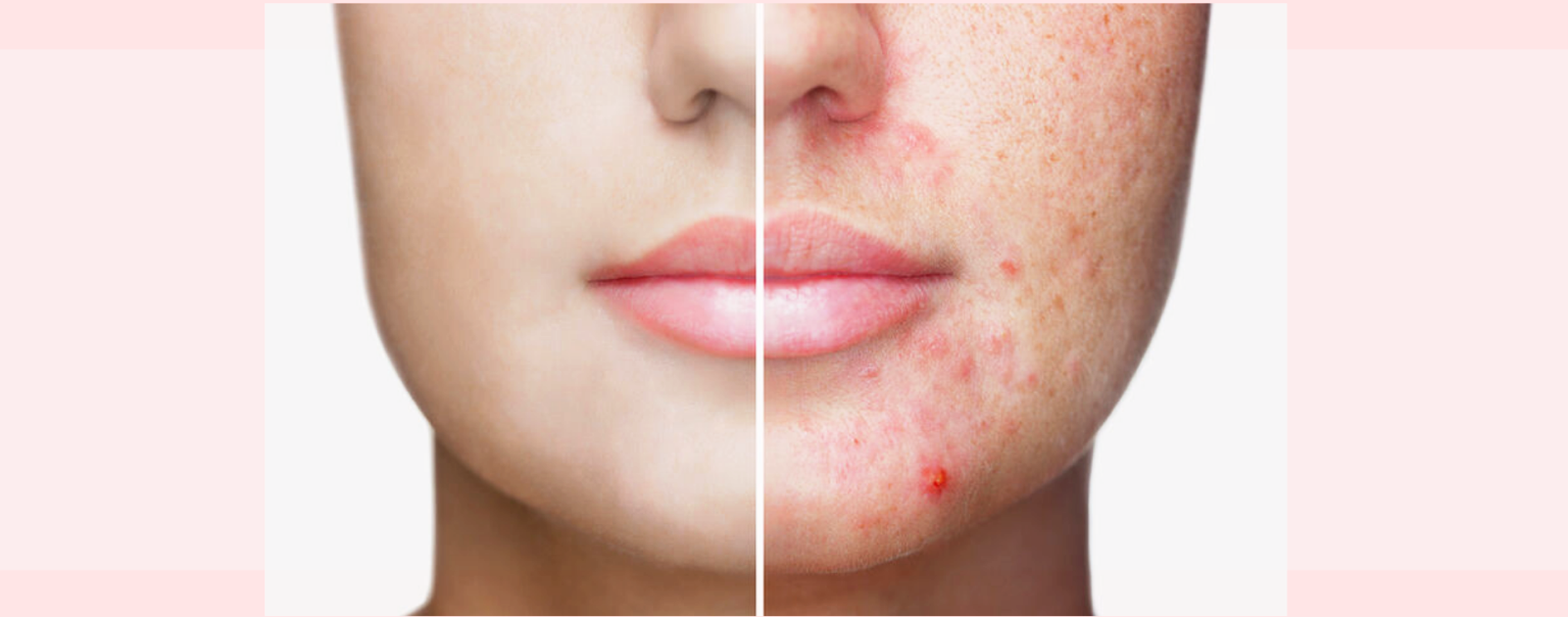 ΚΑΛΛΥΝΤΙΚΑ ΓΙΑ ΤΗΝ ΑΚΜΗ