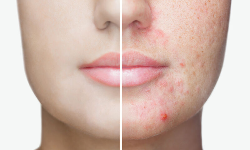 ΚΑΛΛΥΝΤΙΚΑ ΓΙΑ ΤΗΝ ΑΚΜΗ